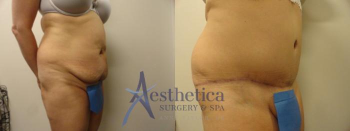 Tummy Tuck Case 293 Before & After View #4 | Columbus, OH | Aesthetica Surgery & Spa