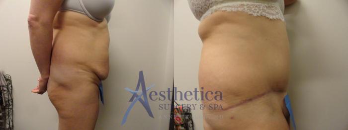 Tummy Tuck Case 293 Before & After View #5 | Columbus, OH | Aesthetica Surgery & Spa