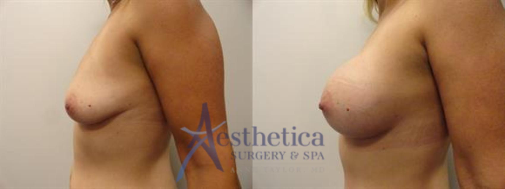 Tummy Tuck Case 294 Before & After View #3 | Columbus, OH | Aesthetica Surgery & Spa