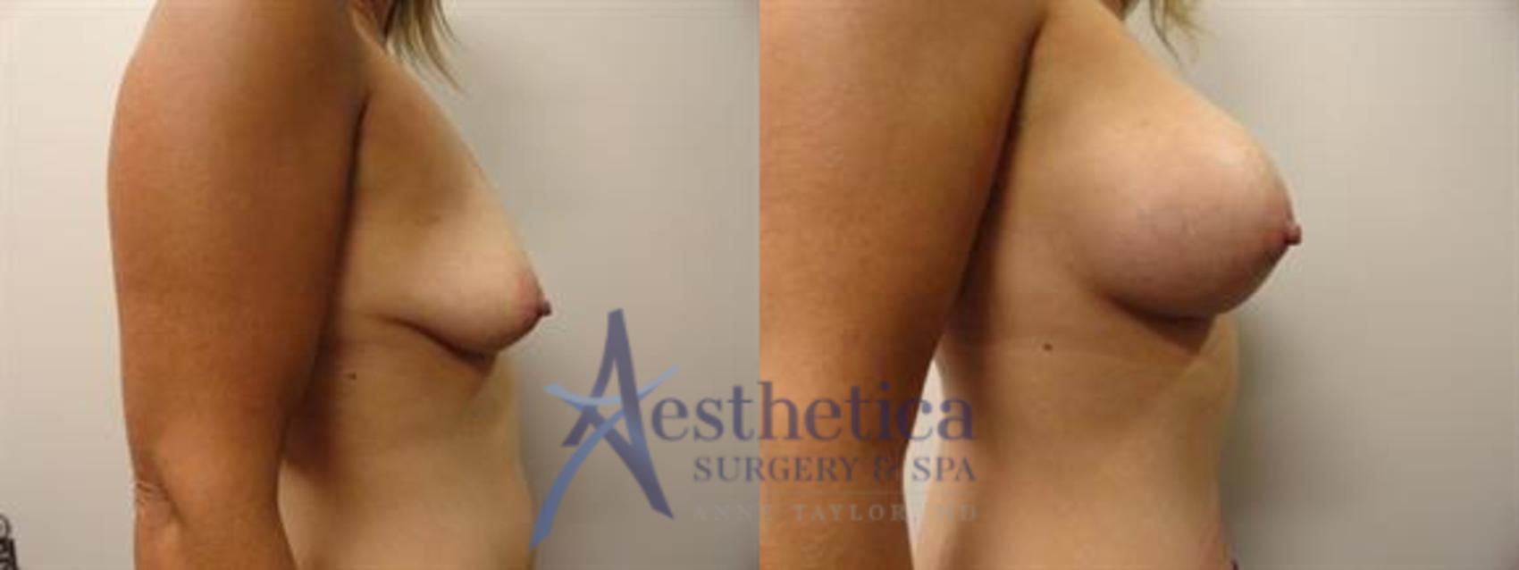Tummy Tuck Case 294 Before & After View #5 | Columbus, OH | Aesthetica Surgery & Spa