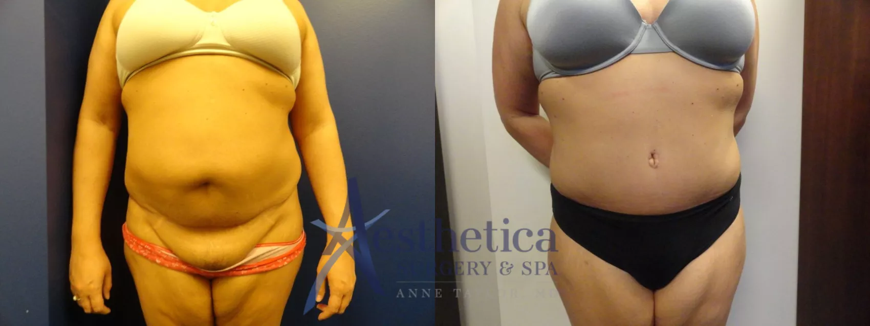 Patient #296 Tummy Tuck Before and After Photos Denver, CO