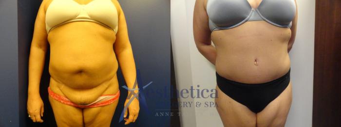 Patient #296 Tummy Tuck Before and After Photos Denver, CO - Plastic  Surgery Gallery ABS Institute
