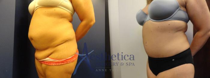 Tummy Tuck Case 297 Before & After View #2 | Columbus, OH | Aesthetica Surgery & Spa