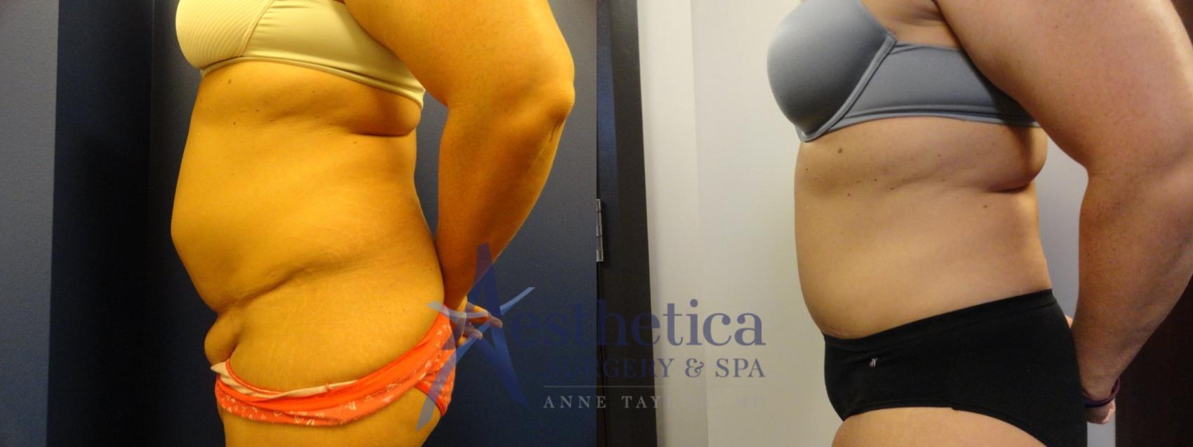 Tummy Tuck Case 297 Before & After View #3 | Columbus, OH | Aesthetica Surgery & Spa