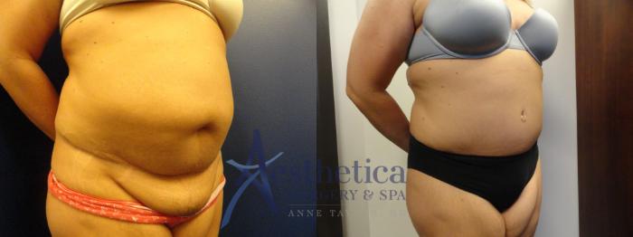 Tummy Tuck Case 297 Before & After View #4 | Columbus, OH | Aesthetica Surgery & Spa