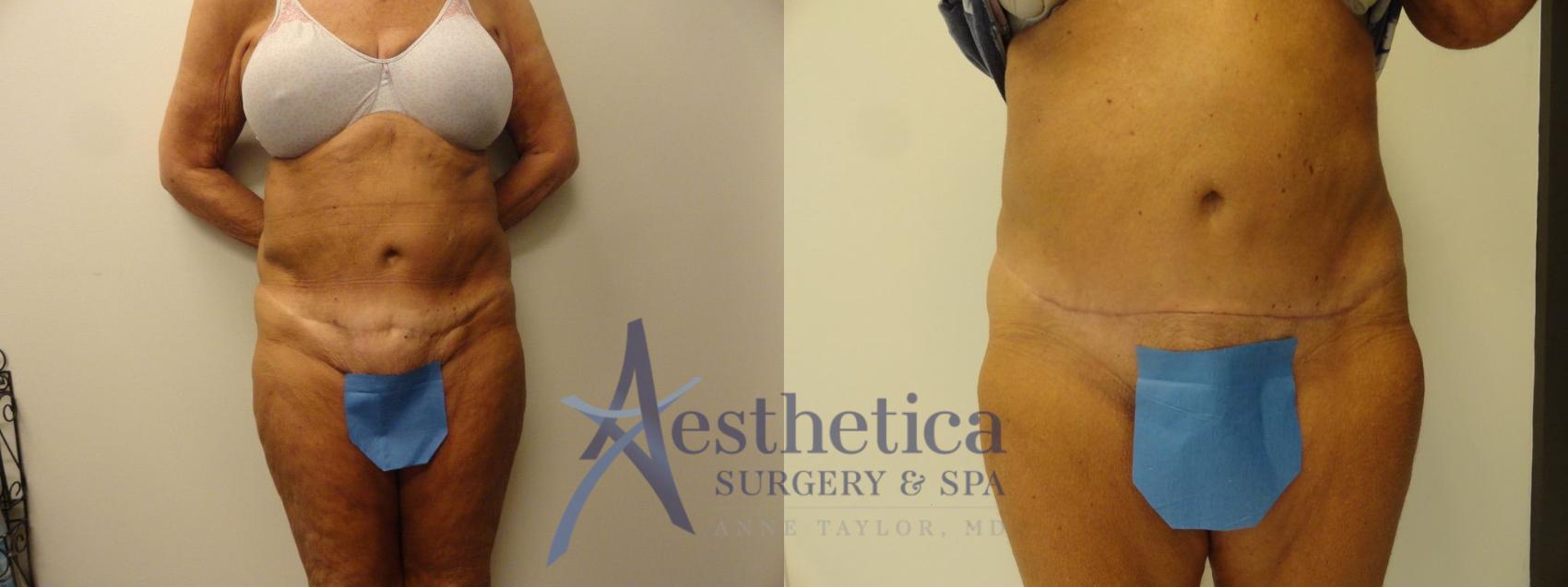 Tummy Tuck Case 298 Before & After View #1 | Columbus, OH | Aesthetica Surgery & Spa