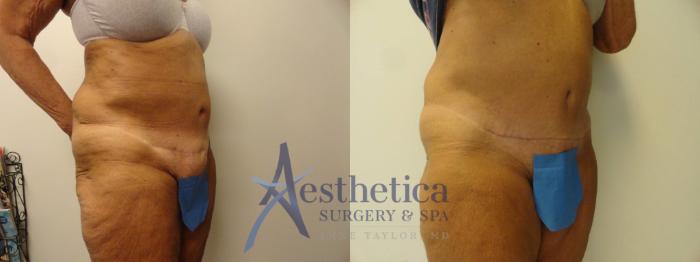 Tummy Tuck Case 298 Before & After View #2 | Columbus, OH | Aesthetica Surgery & Spa