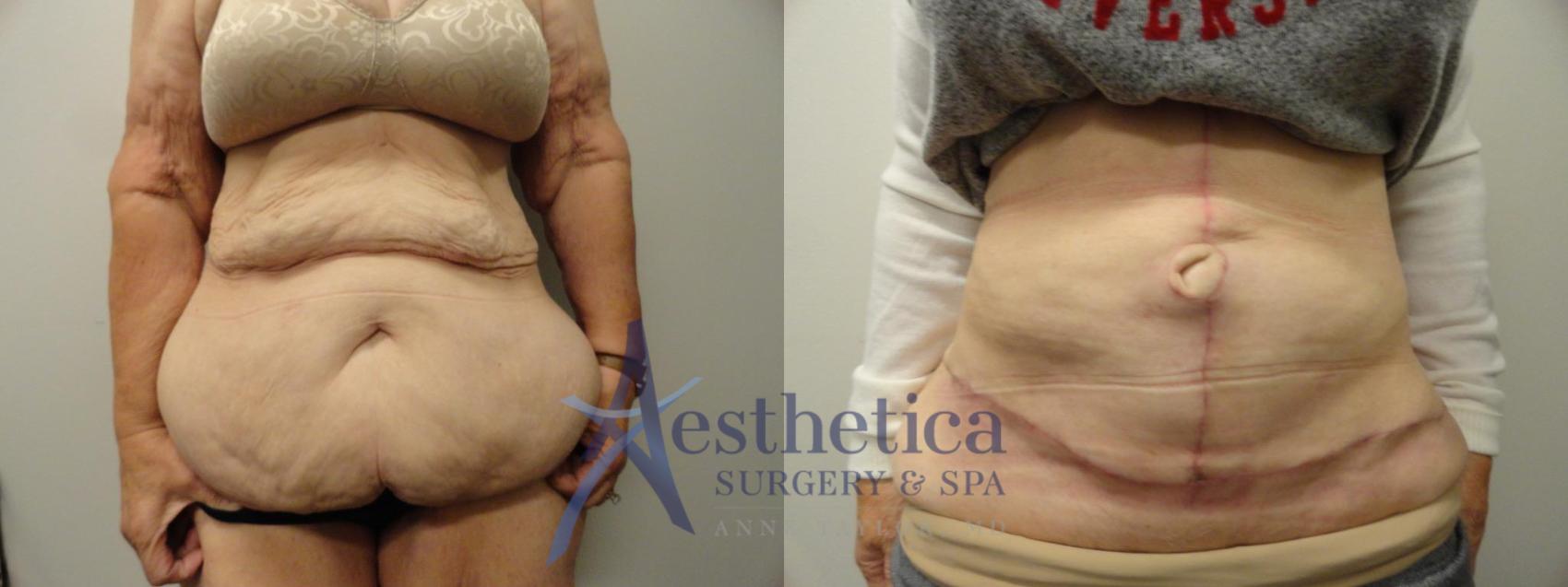 Tummy Tuck Case 301 Before & After View #1 | Columbus, OH | Aesthetica Surgery & Spa