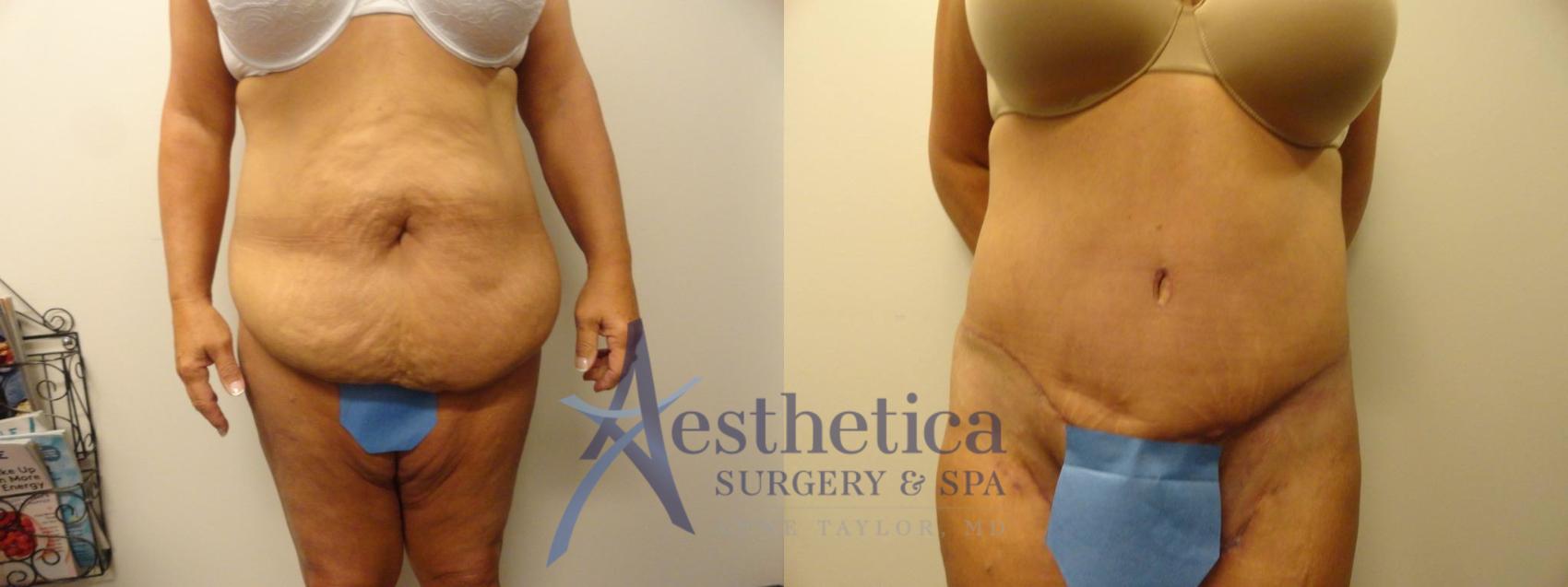 Tummy Tuck Case 305 Before & After View #1 | Worthington, OH | Aesthetica Surgery & Spa