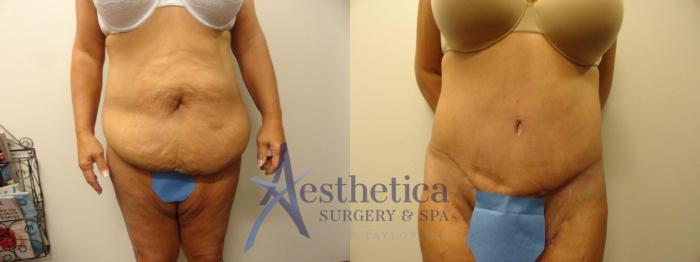 Tummy Tuck Case 305 Before & After View #1 | Columbus, OH | Aesthetica Surgery & Spa