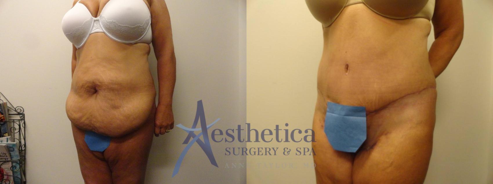 Tummy Tuck Case 305 Before & After View #2 | Worthington, OH | Aesthetica Surgery & Spa