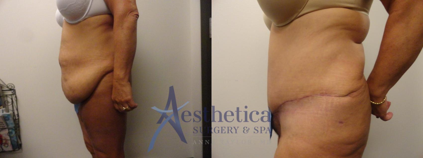 Tummy Tuck Case 305 Before & After View #3 | Worthington, OH | Aesthetica Surgery & Spa