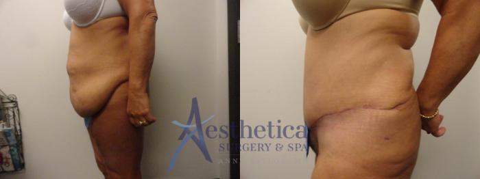 Tummy Tuck Case 305 Before & After View #3 | Columbus, OH | Aesthetica Surgery & Spa