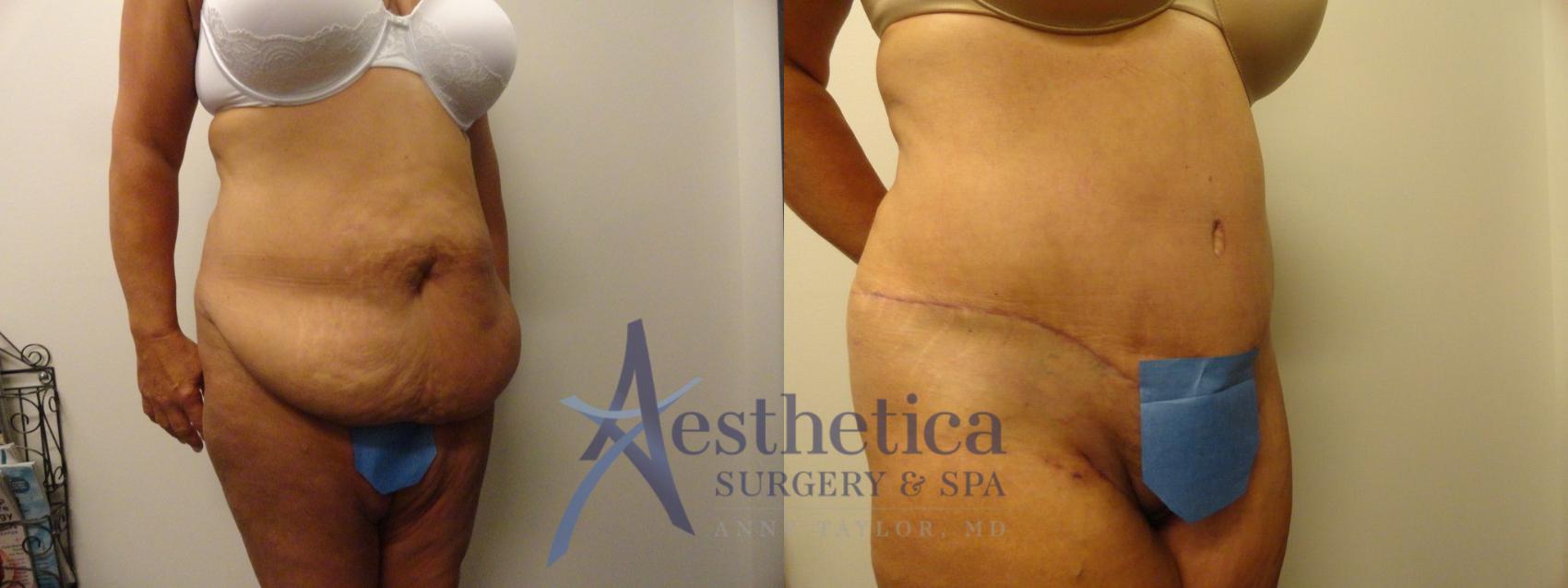 Tummy Tuck Case 305 Before & After View #4 | Worthington, OH | Aesthetica Surgery & Spa