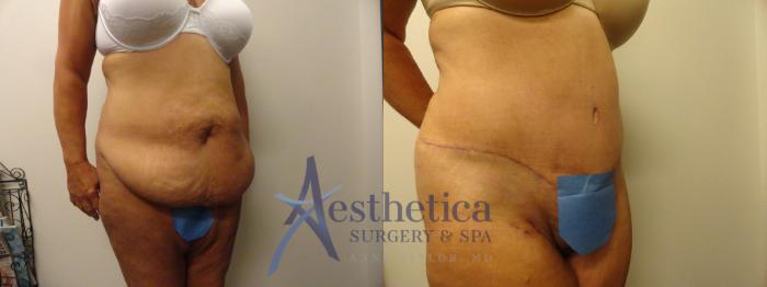 Tummy Tuck Case 305 Before & After View #4 | Columbus, OH | Aesthetica Surgery & Spa