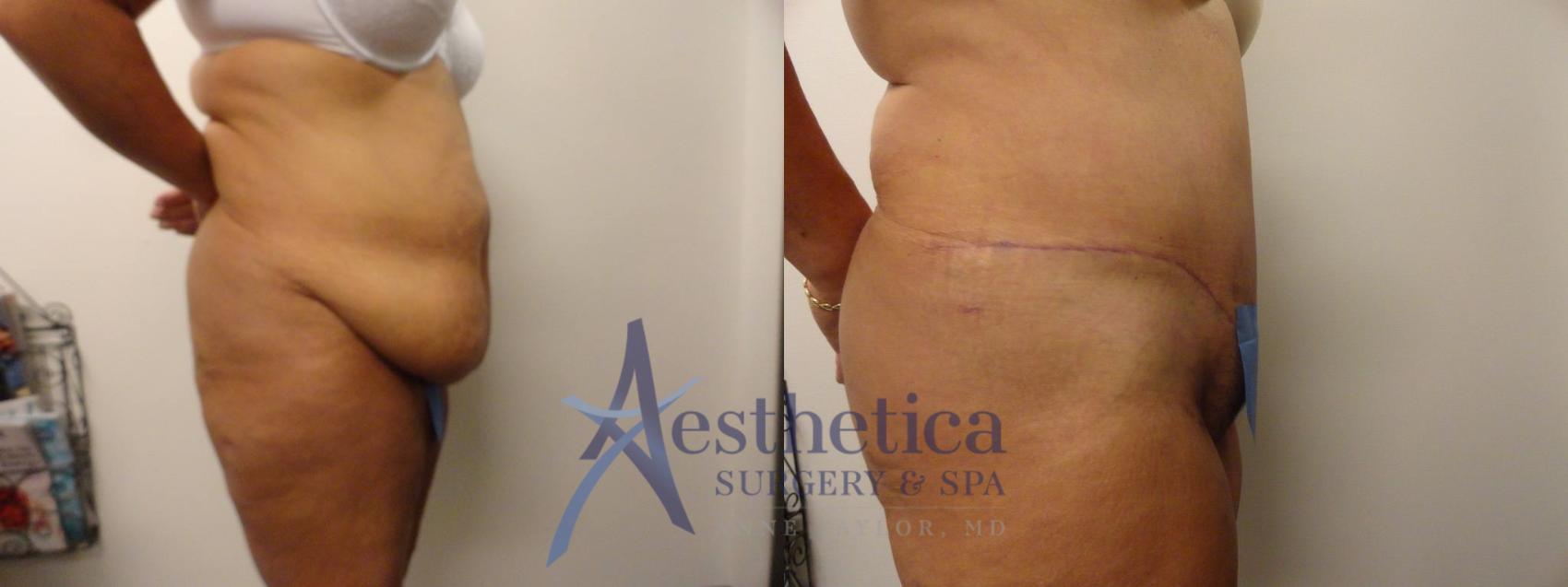 Tummy Tuck Case 305 Before & After View #5 | Worthington, OH | Aesthetica Surgery & Spa