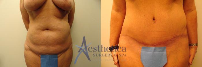 Tummy Tuck Case 309 Before & After View #1 | Columbus, OH | Aesthetica Surgery & Spa