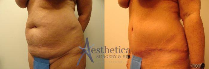 Tummy Tuck Case 309 Before & After View #2 | Columbus, OH | Aesthetica Surgery & Spa