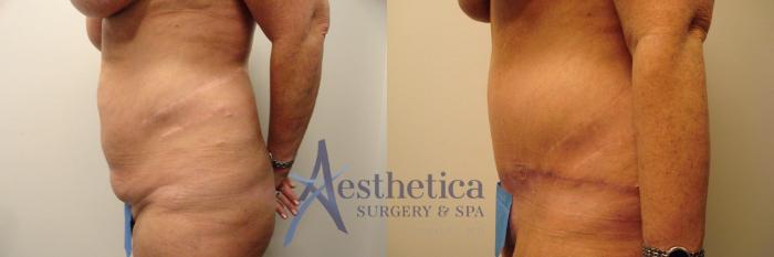 Tummy Tuck Case 309 Before & After View #3 | Columbus, OH | Aesthetica Surgery & Spa