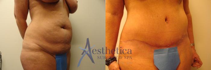 Tummy Tuck Case 309 Before & After View #4 | Columbus, OH | Aesthetica Surgery & Spa