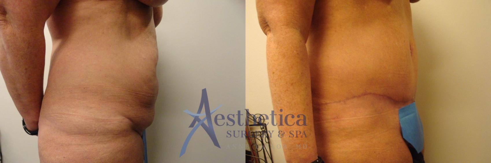 Tummy Tuck Case 309 Before & After View #5 | Columbus, OH | Aesthetica Surgery & Spa