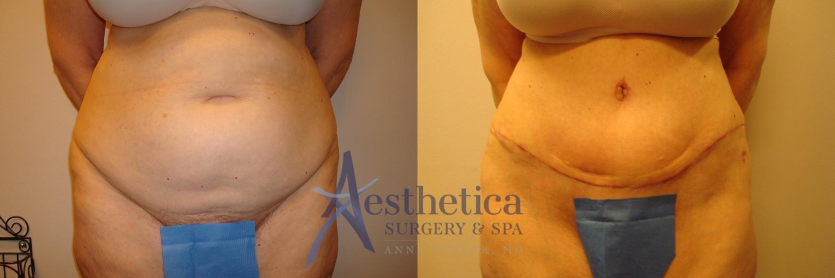 Tummy Tuck Case 310 Before & After View #1 | Columbus, OH | Aesthetica Surgery & Spa