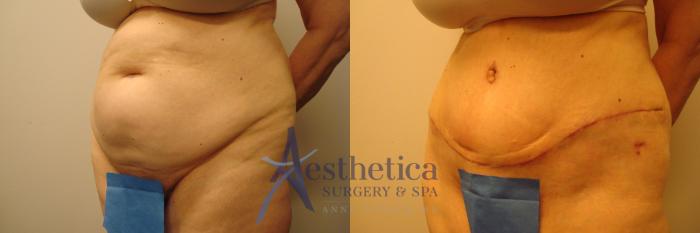 Tummy Tuck Case 310 Before & After View #2 | Columbus, OH | Aesthetica Surgery & Spa