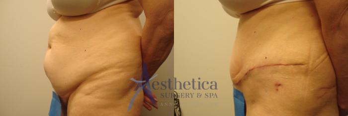 Tummy Tuck Case 310 Before & After View #3 | Columbus, OH | Aesthetica Surgery & Spa