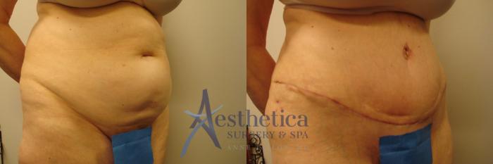 Tummy Tuck Case 310 Before & After View #4 | Columbus, OH | Aesthetica Surgery & Spa