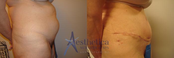 Tummy Tuck Case 310 Before & After View #5 | Columbus, OH | Aesthetica Surgery & Spa