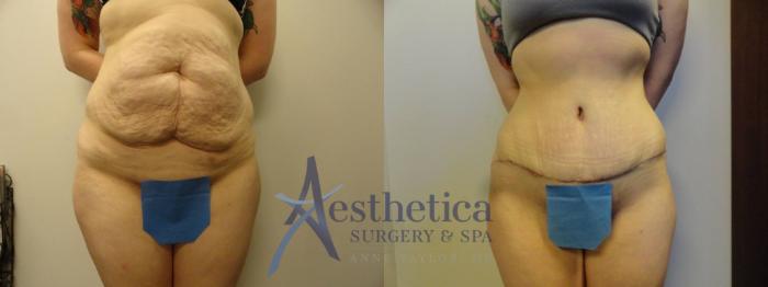 Tummy Tuck Case 312 Before & After View #1 | Columbus, OH | Aesthetica Surgery & Spa