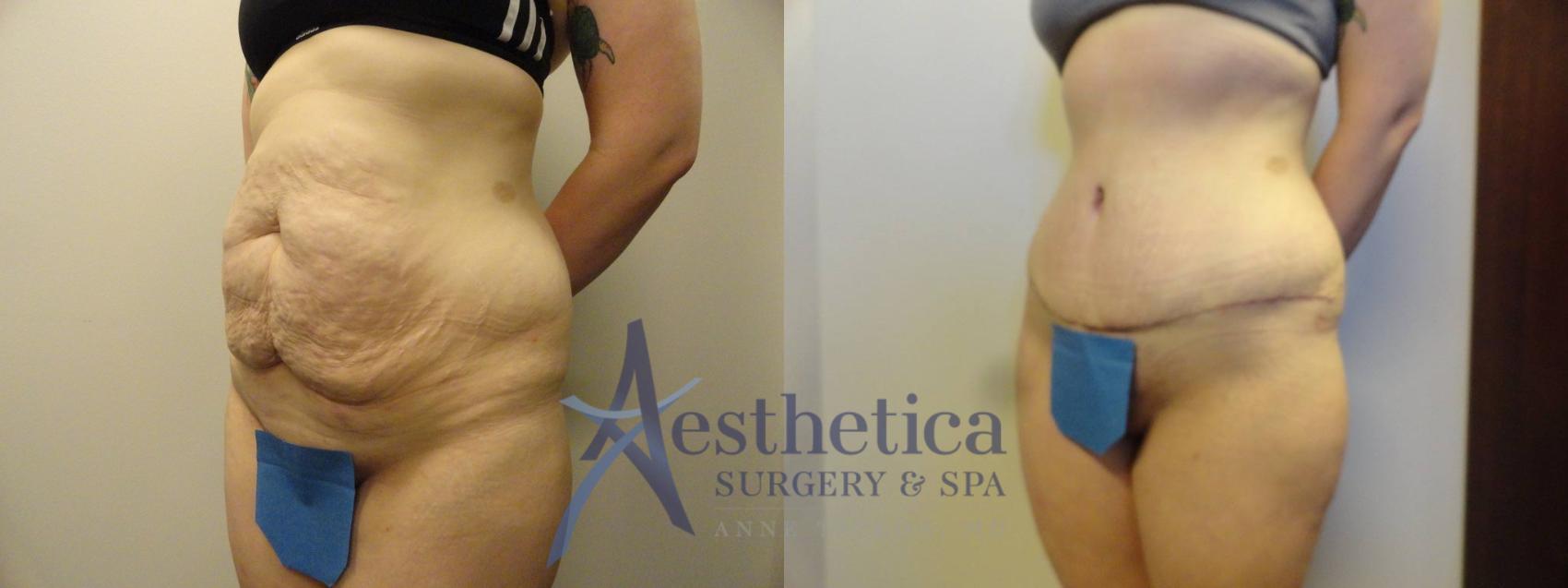 Tummy Tuck Case 312 Before & After View #2 | Worthington, OH | Aesthetica Surgery & Spa