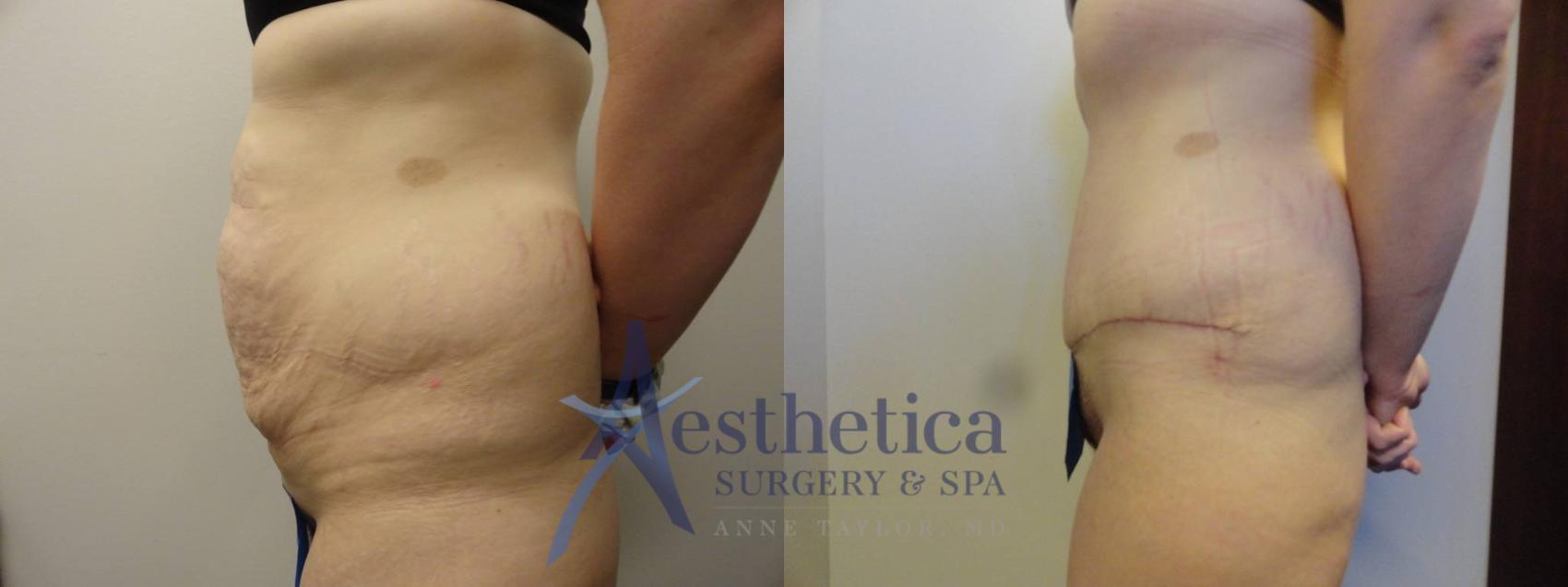 Tummy Tuck Case 312 Before & After View #3 | Columbus, OH | Aesthetica Surgery & Spa
