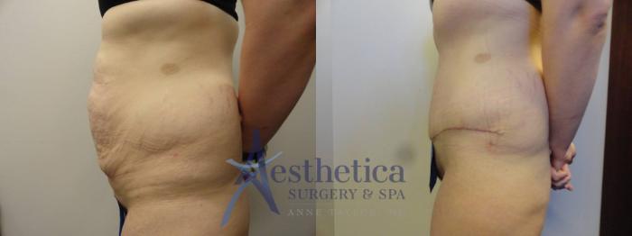Tummy Tuck Case 312 Before & After View #3 | Columbus, OH | Aesthetica Surgery & Spa