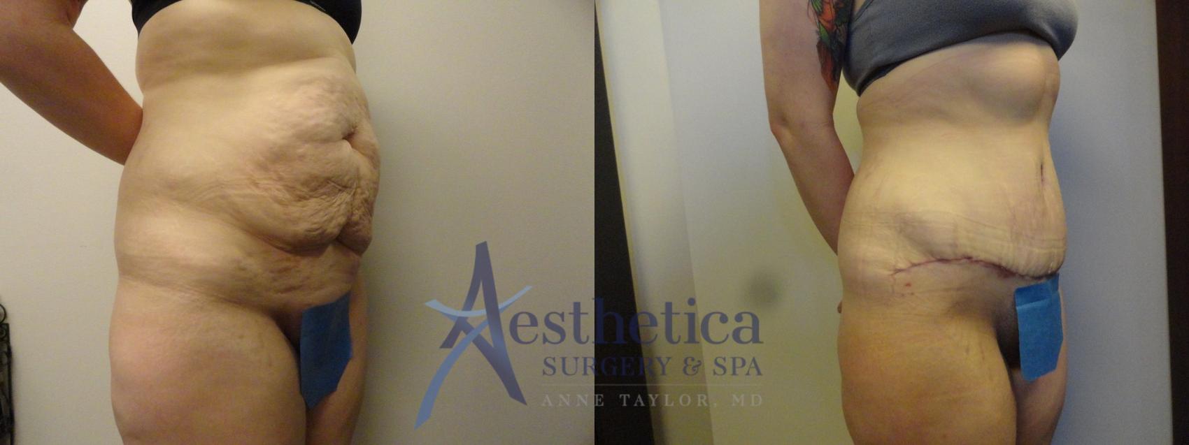 Tummy Tuck Case 312 Before & After View #4 | Columbus, OH | Aesthetica Surgery & Spa