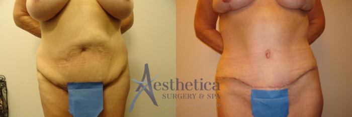 Tummy Tuck Case 313 Before & After View #1 | Columbus, OH | Aesthetica Surgery & Spa