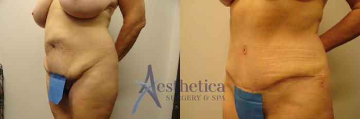Tummy Tuck Case 313 Before & After View #2 | Columbus, OH | Aesthetica Surgery & Spa