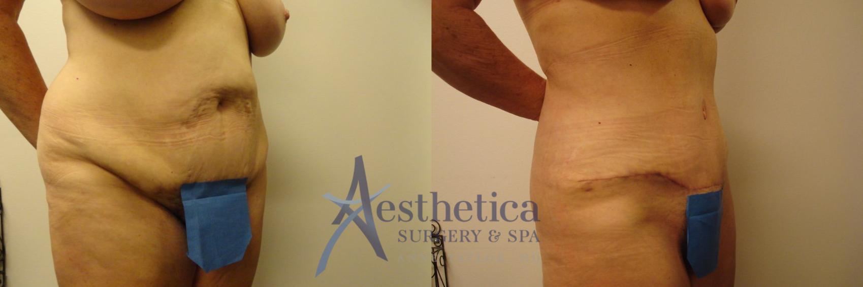 Tummy Tuck Case 313 Before & After View #3 | Columbus, OH | Aesthetica Surgery & Spa