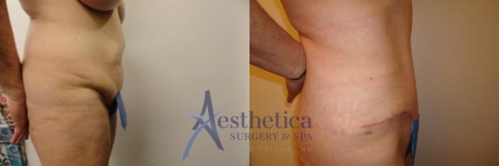 Tummy Tuck Case 313 Before & After View #4 | Columbus, OH | Aesthetica Surgery & Spa