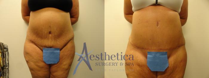 Tummy Tuck Case 338 Before & After View #1 | Columbus, OH | Aesthetica Surgery & Spa