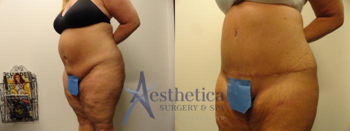 Tummy Tuck Case 338 Before & After View #2 | Columbus, OH | Aesthetica Surgery & Spa