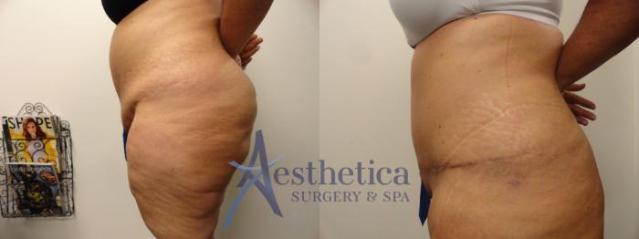 Tummy Tuck Case 338 Before & After View #3 | Columbus, OH | Aesthetica Surgery & Spa