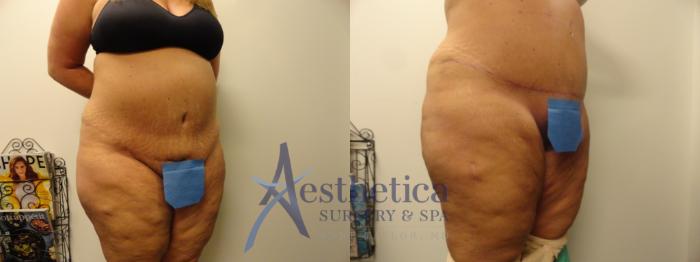 Tummy Tuck Case 338 Before & After View #4 | Columbus, OH | Aesthetica Surgery & Spa