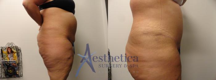 Tummy Tuck Case 338 Before & After View #5 | Columbus, OH | Aesthetica Surgery & Spa