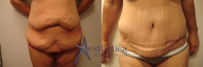 Tummy Tuck Case 357 Before & After View #1 | Columbus, OH | Aesthetica Surgery & Spa
