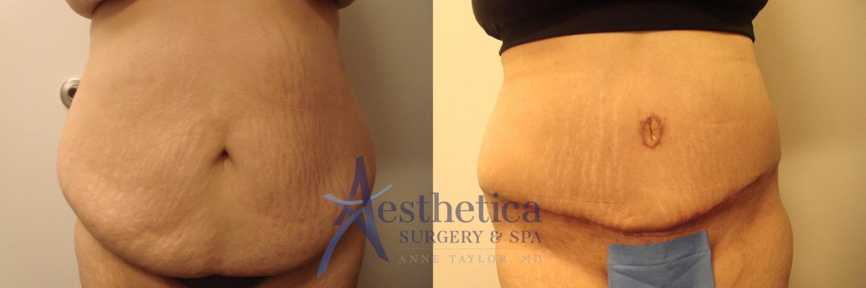 Tummy Tuck Case 365 Before & After View #1 | Worthington, OH | Aesthetica Surgery & Spa