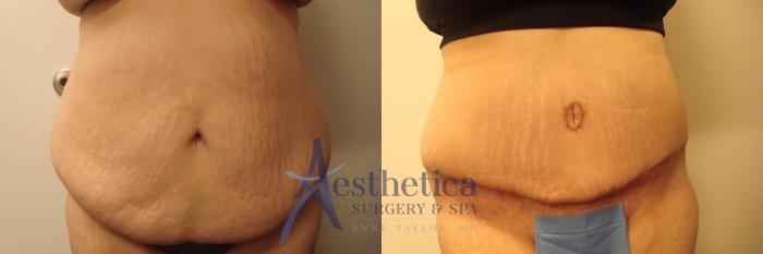 Tummy Tuck Case 365 Before & After View #1 | Columbus, OH | Aesthetica Surgery & Spa