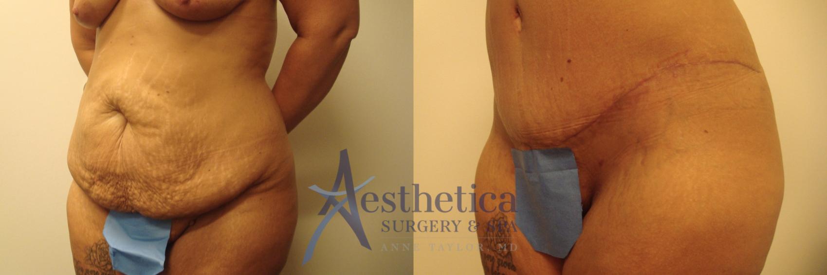 Tummy Tuck Case 368 Before & After View #1 | Columbus, OH | Aesthetica Surgery & Spa