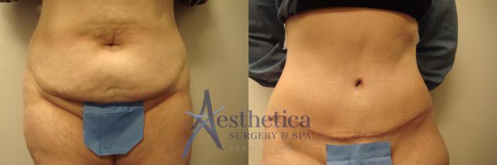 Tummy Tuck Case 425 Before & After View #1 | Columbus, OH | Aesthetica Surgery & Spa