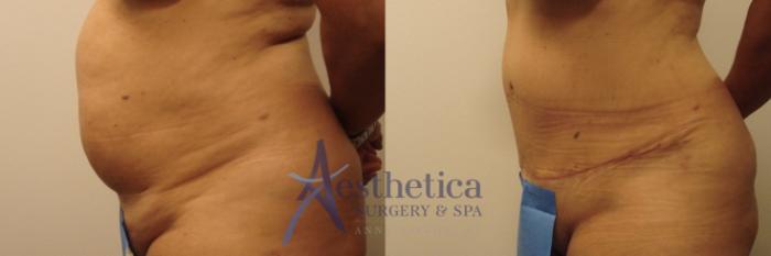 Tummy Tuck Case 439 Before & After Front | Columbus, OH | Aesthetica Surgery & Spa